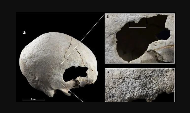 کشف اسکلت زنی که 4500 سال قبل دو بار جمجمه‌اش جراحی شده بود
