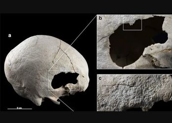 کشف اسکلت زنی که 4500 سال قبل دو بار جمجمه‌اش جراحی شده بود