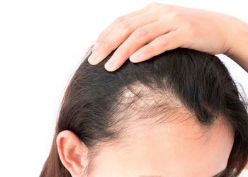 دلایل ریزش موی جلوی سر در زنان